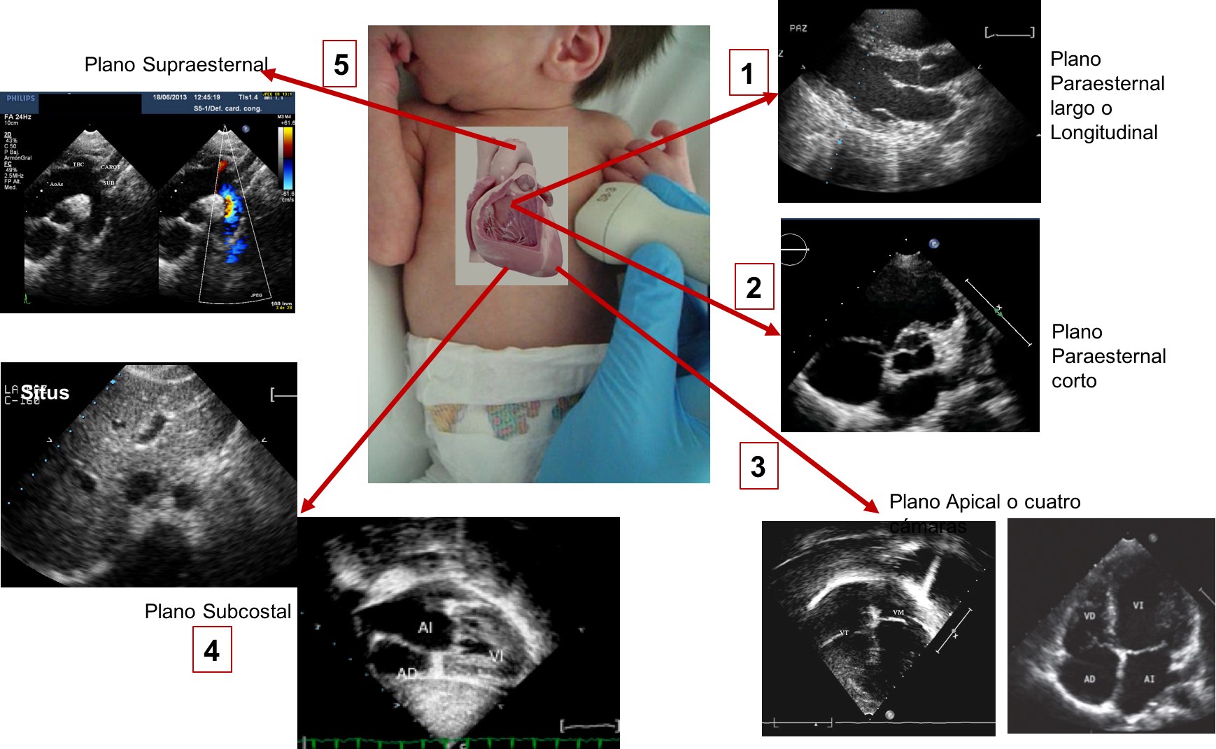 Curso De Ecocardiograf A B Sica En Pediatr A Niakoro